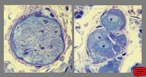Methylene-blue-stained epoxy-resin semithin section of intestinal unmyelinated vegetative nerve (left)and ganglion cells of plexus submucosus Meissneri (right). (Human, small intestine.)